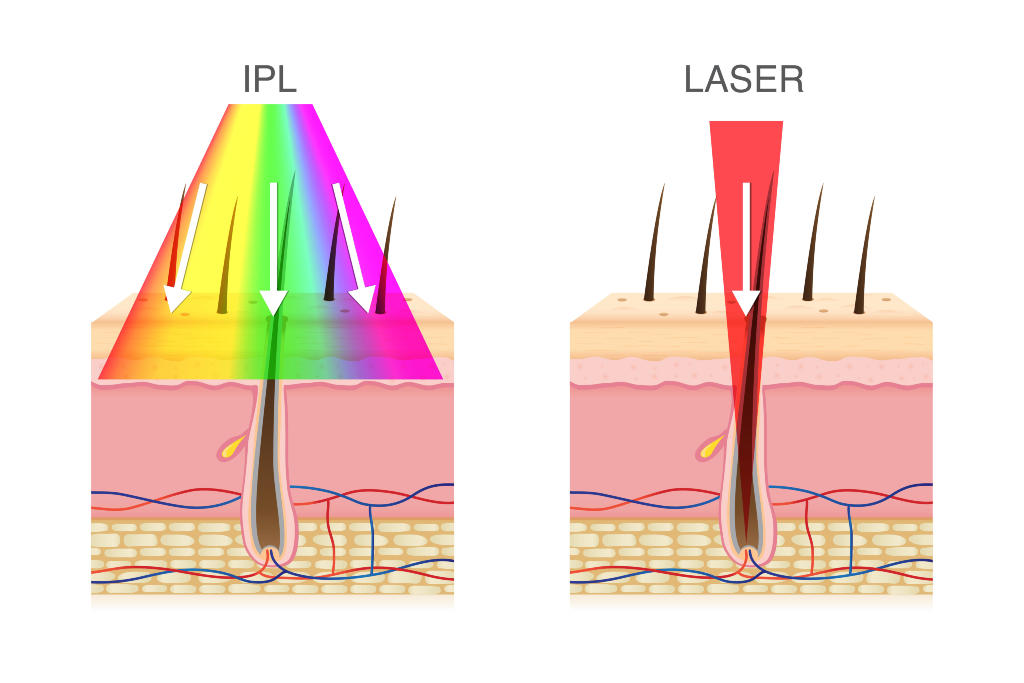 IPL vs. Laser Eye Treatment by Eye Associates of Fort Myers, FL
