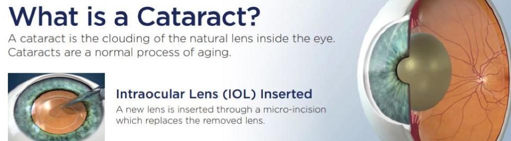 Cataracts Eyes | How to treat cataracts eyes by Eye Associates