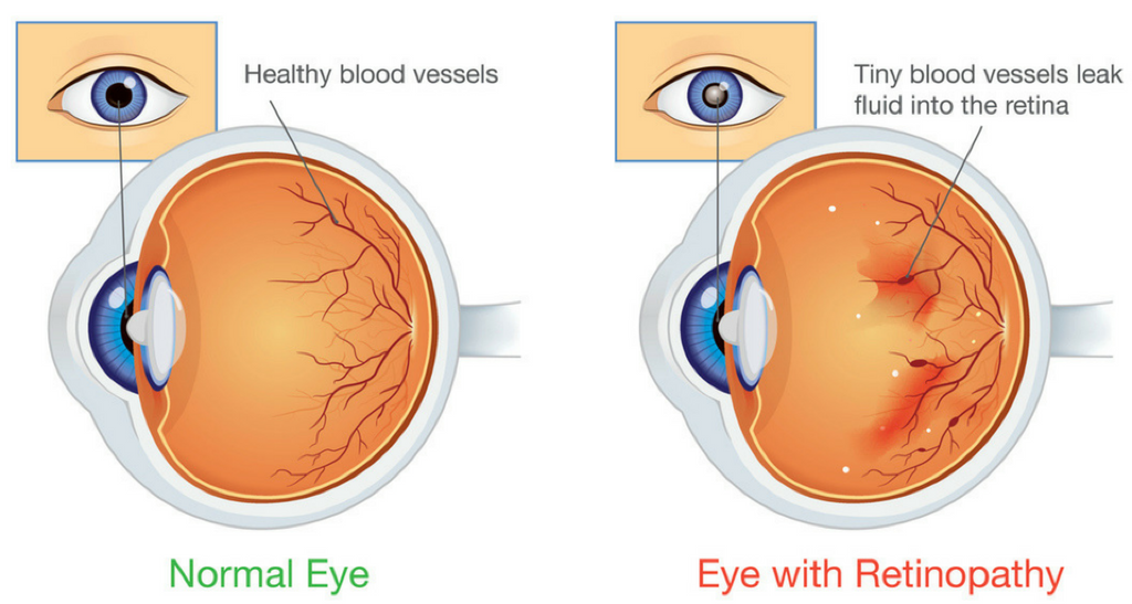 Diabetic Eye Care at Eye Associates of Fort Myers and Naples